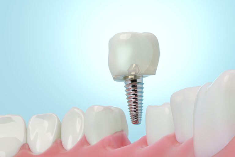 Tooth Replacement Options Round Rock